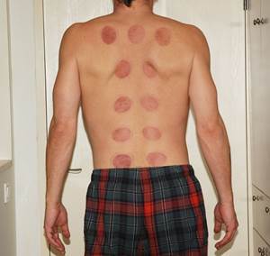 Acupuncture Marks on a Man's Back